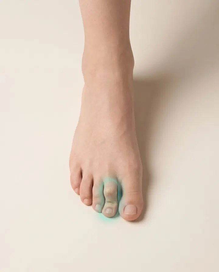 A foot with a curled second toe highlighted
